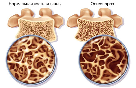 Остеопороз лечение Молдова 